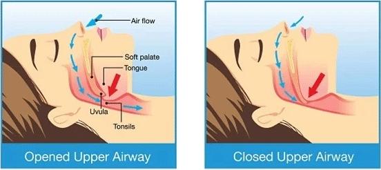 Diagram of upper-airway collapse that causes snoring